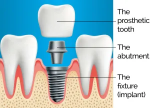 Dental Implants Jersey City Nj 